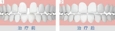 牙齿楔状缺损修复治疗