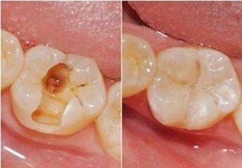 牙套一个月就掉正常吗