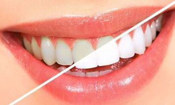 牙套分为哪几种阶段(牙套材质分为哪几种)