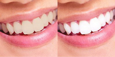 戴牙套牙龈增生如何治疗