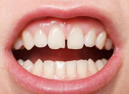 种植完牙牙龈溃疡(种植牙牙龈有溃疡)