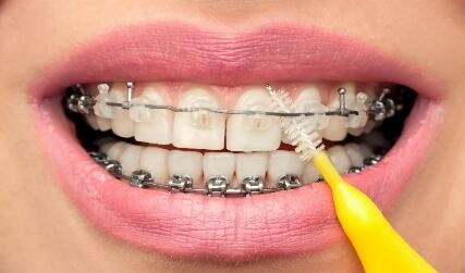 树脂材料补牙是什么颜色的(树脂补牙垫底用什么材料好)