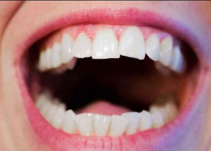 牙齿整形后反弹的原因有什么