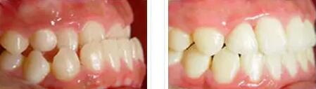 根管治疗牙龈长白脓包