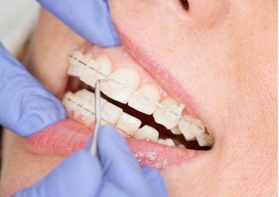 牙齿种植过程是什么