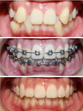 牙齿修复方式对比[缺失一颗牙齿修复方式]