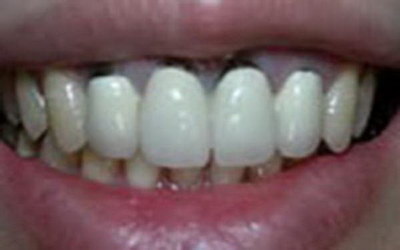 牙齿整形后如何护理牙齿(牙齿整形后如何护理)