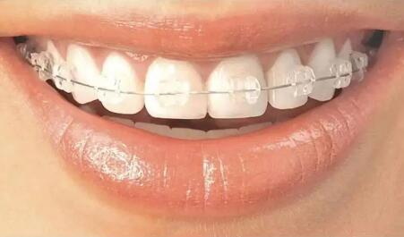 牙齿白点修复_去除牙齿白点