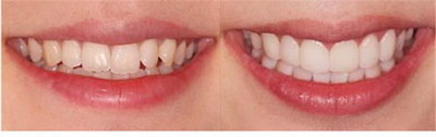 牙齿矫正方式都有什么呢？