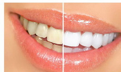 烤瓷牙修复美容牙齿的方式是什么呢？