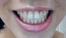 牙齿大小不一样有什么区别【牙齿大小不一样可以磨吗】