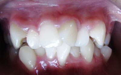 牙龈萎缩带牙套有作用吗(牙龈萎缩带牙套期间)