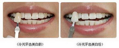 根管治疗后可以补牙再做冠修复么(根管治疗用树脂补牙后两年可以在做牙套吗)