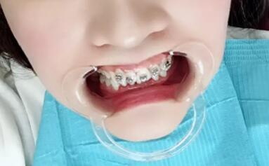 牙齿做根管治疗后不做牙套可以吗(牙齿做了根管治疗后多久戴牙套)
