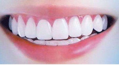 牙根磨损怎么治疗「牙根磨损严重怎么修复」