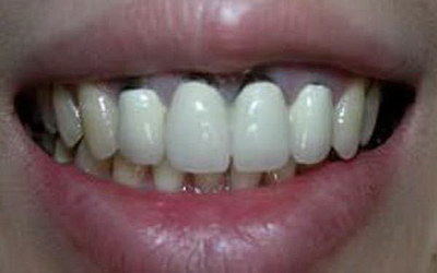 矫正牙齿具体过程是怎样的(矫正牙齿具体过程是什么)