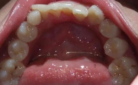 牙齿轻微裂痕(牙齿有轻微裂痕)