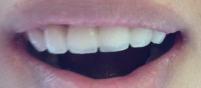 金属牙会导致牙龈萎缩吗[金属牙套会导致牙龈萎缩吗]