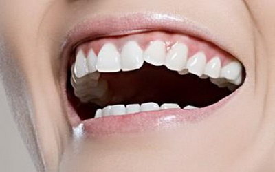 二氧化锆全瓷牙的种类