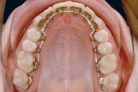 牙齿高嵌体可以用几年(什么是高嵌体)