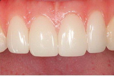 牙齿安抚治疗步骤(牙齿安抚治疗是什么)