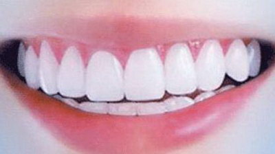 牙齿的根管治疗是什么样子的[根管治疗牙齿劈裂是什么样的]
