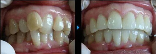 儿童牙脱位的治疗方法