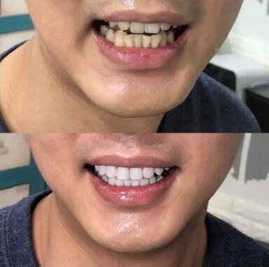 补牙半个月后牙齿痛怎么回事