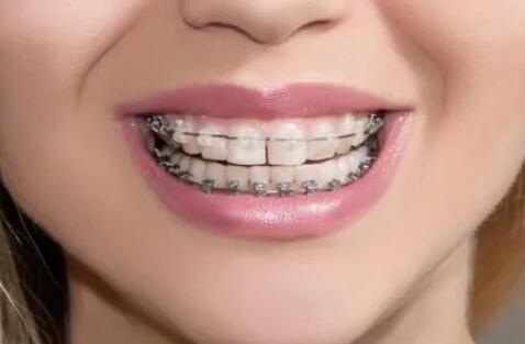 牙齿整形后如何护理牙齿(牙齿整形后如何护理)