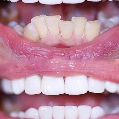 大牙脱落不种植有什么影响