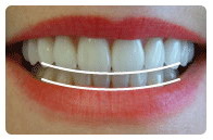 牙齿矫正的这五大误区你了解吗？