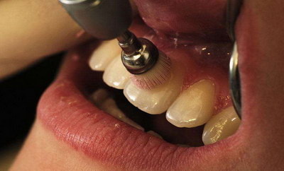 进口树脂补牙能维持多久_进口树脂补牙能用多久