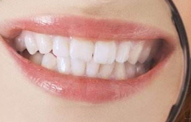 冷光牙齿美白比较简单的方法