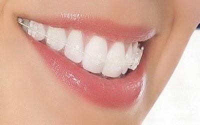 根管治疗后的牙齿如何保护(牙齿根管治疗是如何做的)
