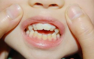 牙龈肉和牙齿分离是什么原因(牙龈和牙齿分离是什么原因)