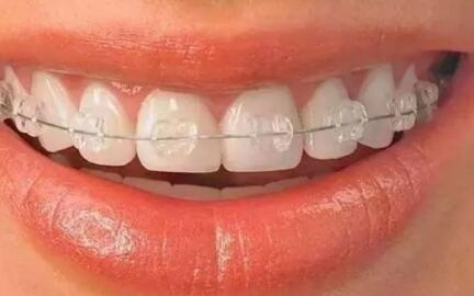 牙科小诊所可以戴牙套吗