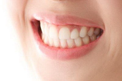 智齿拔牙一般需要多少钱(拔牙一般多少钱一颗智齿)