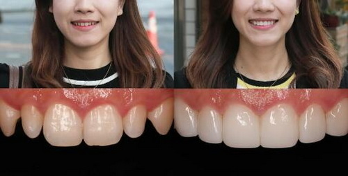牙龈上出现白色的点(牙龈有白色液体在牙齿缝出现)