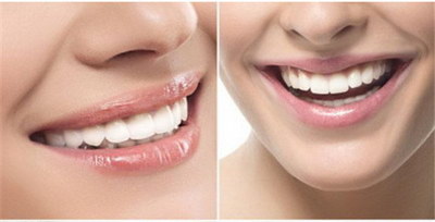 电动牙刷对补牙后的牙齿有危害吗()
