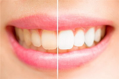 透明矫正牙套一个疗程_透明矫正牙套的评语