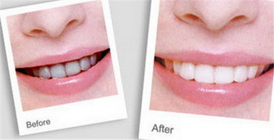 牙齿抛光：一种必要的牙齿保健手段