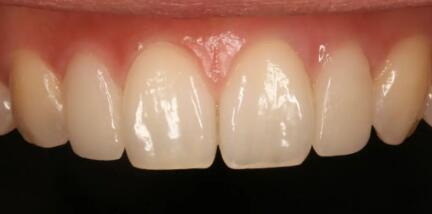 种牙与镶牙的区别「镶牙与种牙有何区别」