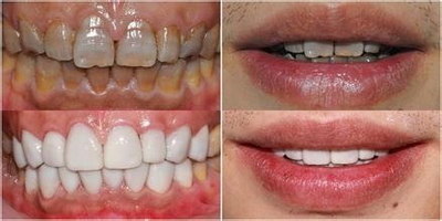 什么方法可以健康牙龈【腋臭有什么方法可以根除】