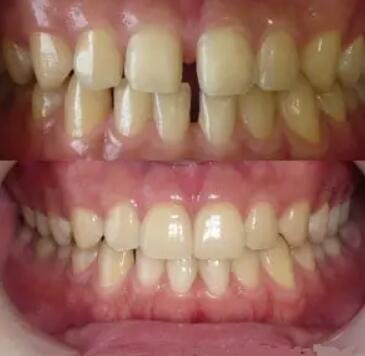 补牙后牙齿敏感「树脂补牙后牙齿敏感」
