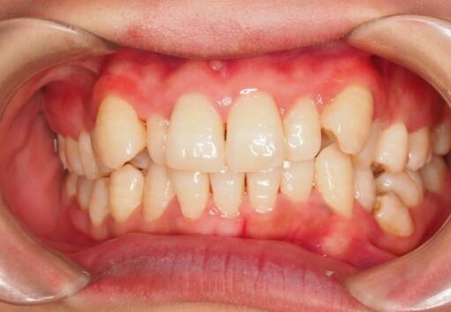 根管治疗牙齿是不是就死了(牙齿根管治疗后是不是要带牙套)