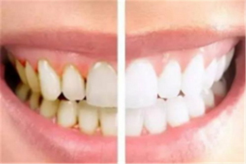 拔牙好吗矫正拔牙是拔的哪几颗呢？