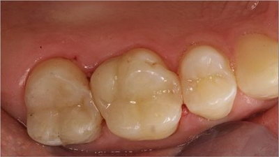 氧化锆牙齿和全瓷牙一样吗(氧化锆牙齿和全瓷牙有哪些区别？)