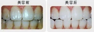 牙齿长黑渍怎么去除「牙齿长黑斑怎么去除牙周炎」