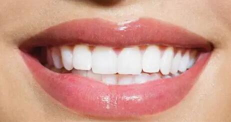 哪种牙齿美白方法比较好[哪种牙齿美白方法不伤牙]