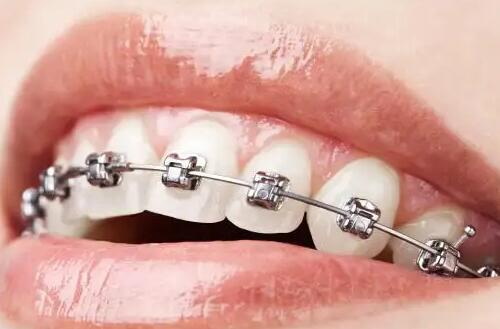 牙齿很整齐可以戴牙套吗